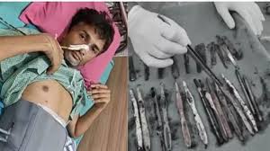 ਨੌਜਵਾਨ ਦੇ ਪੇਟ 'ਚੋਂ ਨਿੱਕਲੇ 29 ਚਮਚੇ, 19 ਟੁੱਥਬ੍ਰਸ਼ ਅਤੇ... ਦੇਖ ਕੇ ਡਾਕਟਰ ਵੀ ਰਹਿ ਗਏ ਹੈਰਾਨ; ਚਾਰ ਘੰਟੇ ਚੱਲਿਆ ਆਪ੍ਰੇਸ਼ਨ